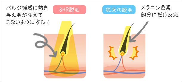 従来の脱毛器(IPL、SSC)との違い